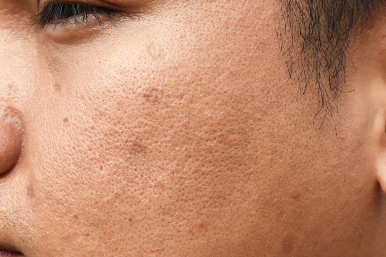 Close-up of tan man with clogged pores looking for the best ways how to treat acne scars