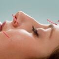 facial acupuncture